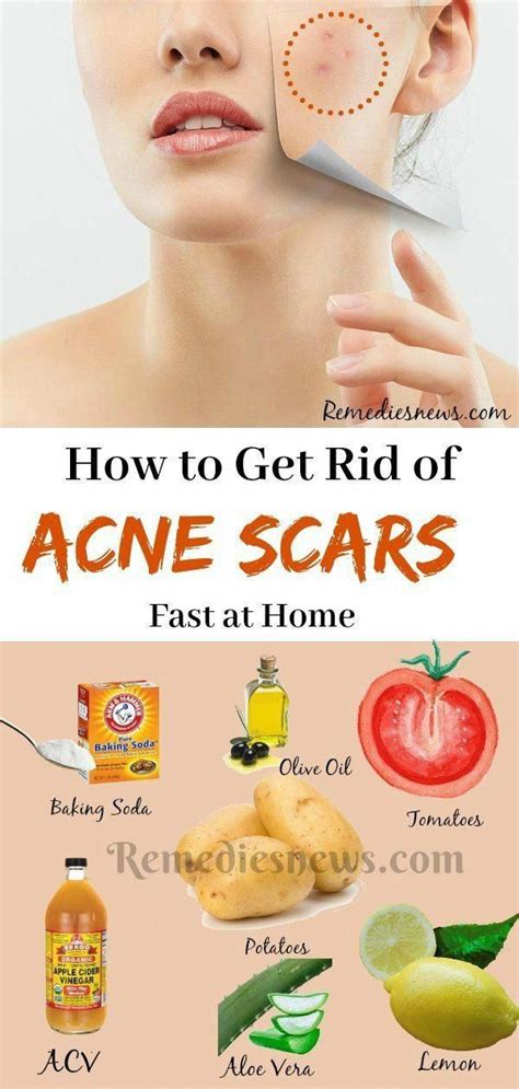 how to remove acne scar fast in one day