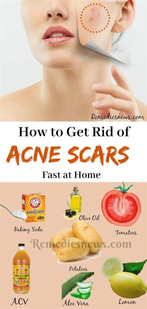 how to remove acne scars fast naturally