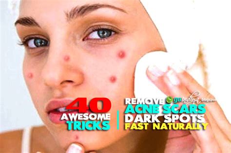 how to remove acne spots fast