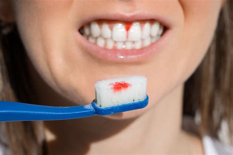 how to stop bleeding gums from brushing too hard