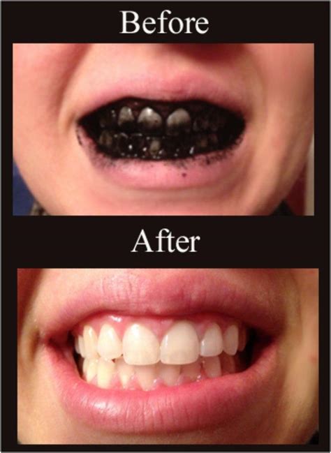 how to use activated charcoal to brush your teeth
