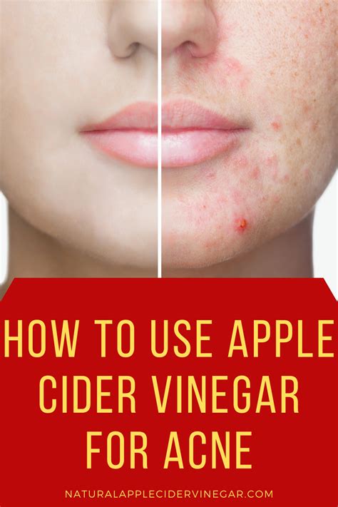 how to use apple cider vinegar on face for pimples