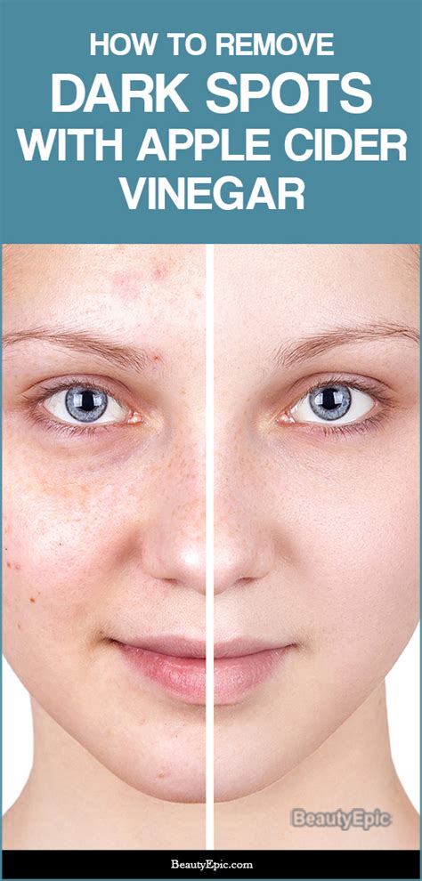 how to use apple cider vinegar to lighten dark spots