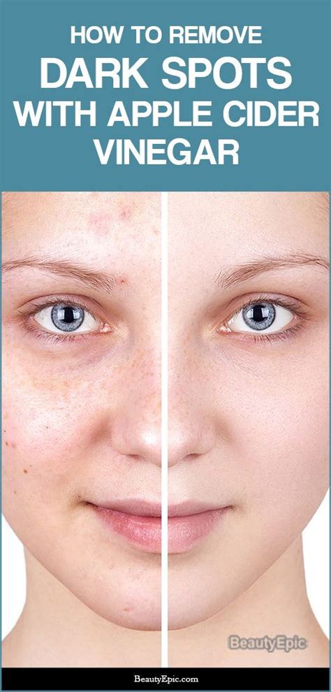 how to use apple cider vinegar to reduce dark spots