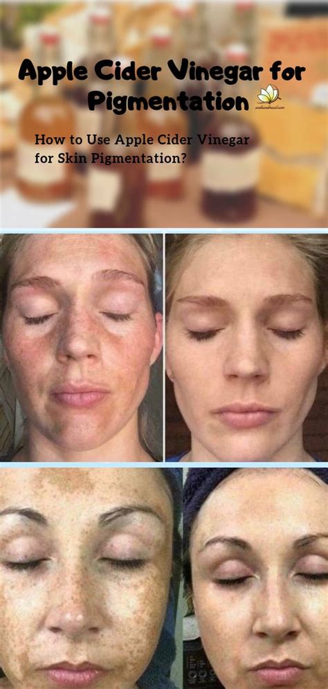 how to use apple cider vinegar to remove pigmentation