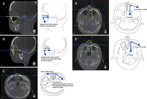 how to.measure maxilla angle