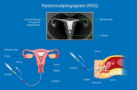 hsg procedure