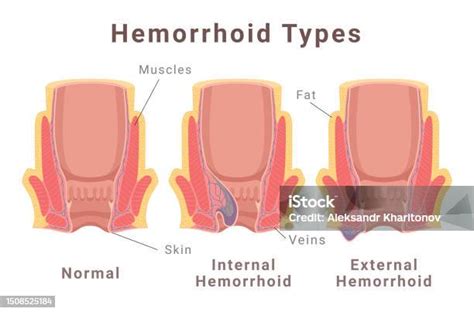 internal dan external hemorrhoid