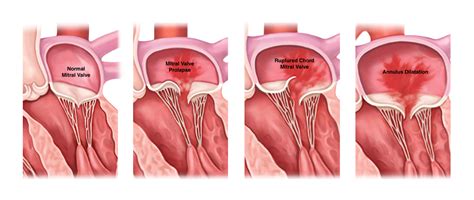 is a leaky mitral valve hereditary