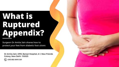 is a ruptured appendix the same as a burst appendix