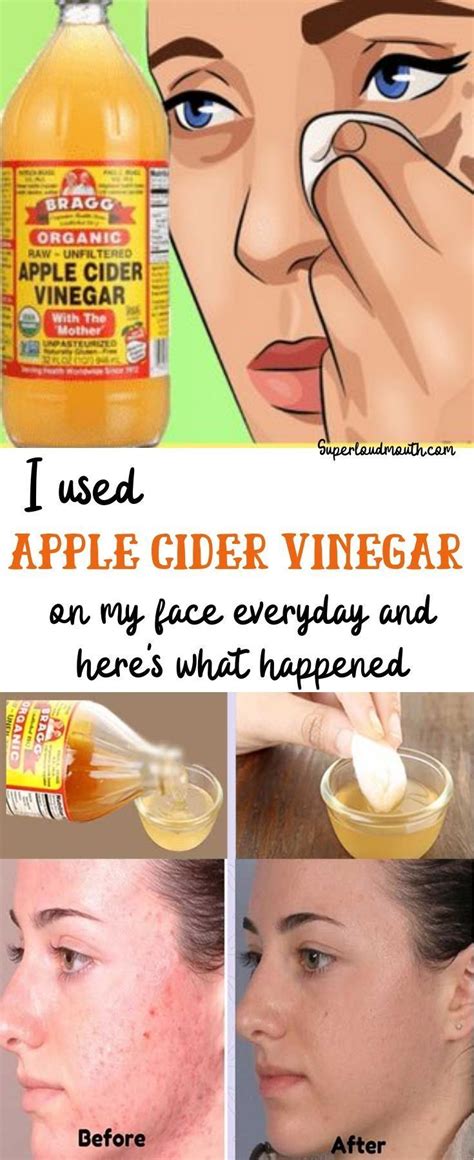 is applying apple cider vinegar good for face
