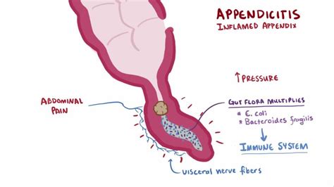 is there a difference between a ruptured appendix and a burst appendix