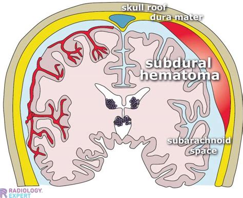 is when there is bleeding into the space between the brain and the skull