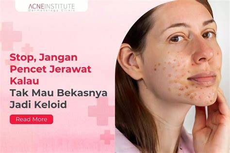 jangan pencet jerawat