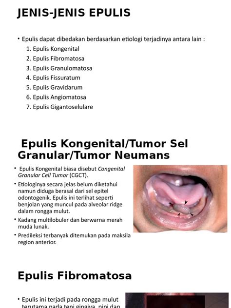 jenis epulis