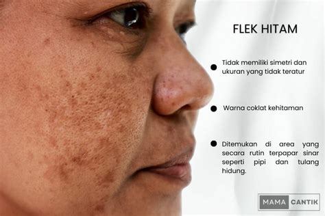 jerawat dan flek hitam