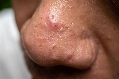 jerawat di hidung