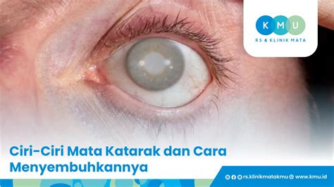 katarak