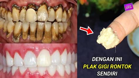 kerak gigi