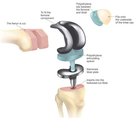 knee replacement surgery diagram
