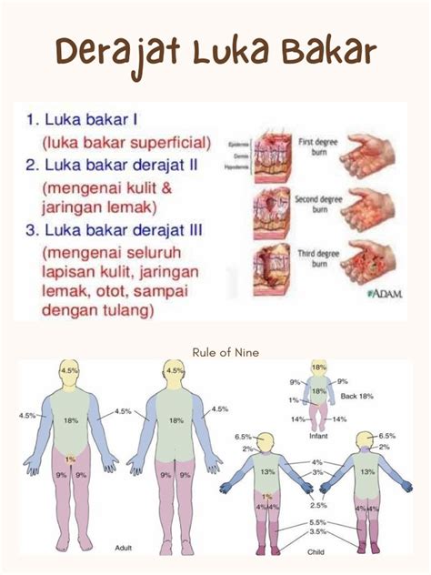 luka bakar derajat