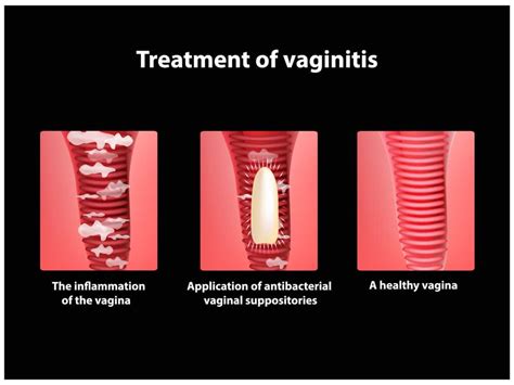 Mencegah infeksi vagina