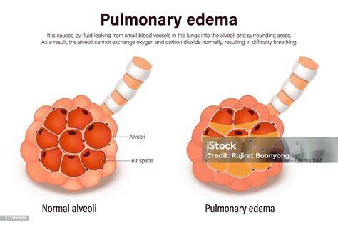 oedema paru