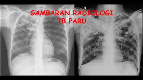 paru paru terinfeksi tb
