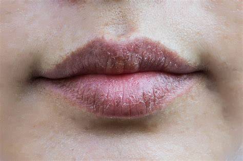 penyebab bibir kering