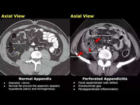 perforated vs burst appendix