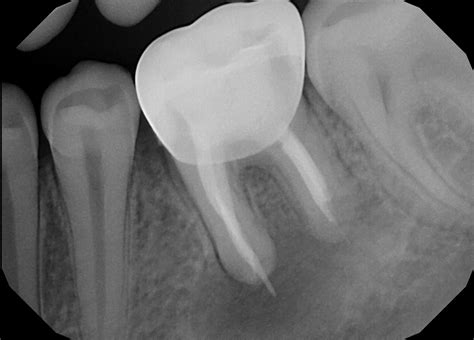 periapical x-rays