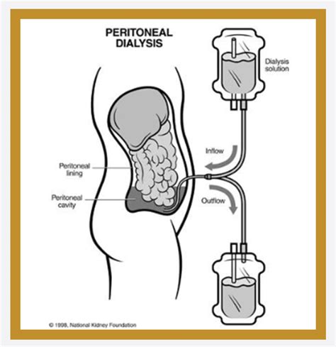 Peritoneal dialisis