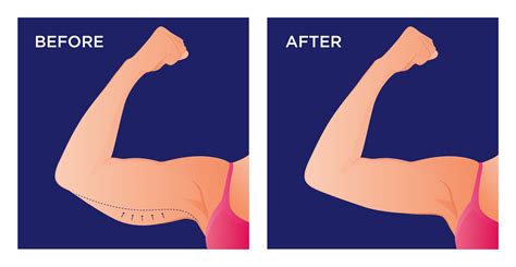 saggy arms before and after exercise