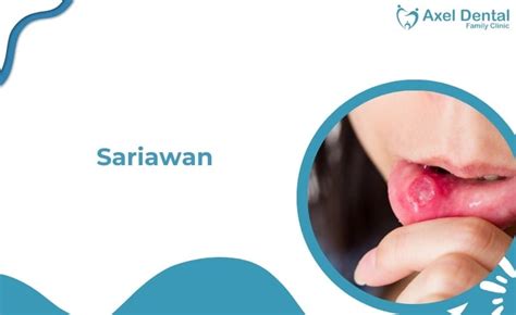 sariawan