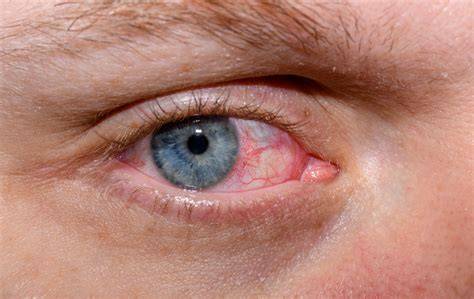 severe dry eye