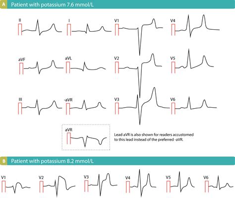 significance of changes of st segment in ecg