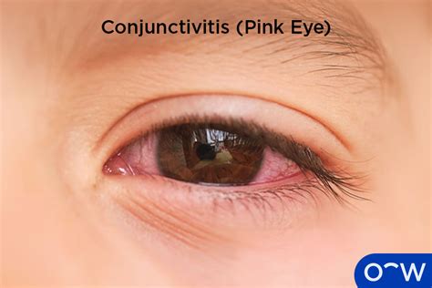 sudden sensitivity to light in both eyes