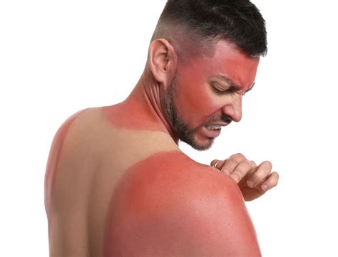 sunburn