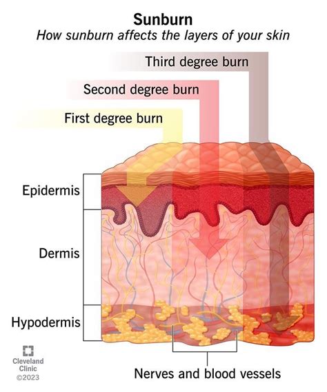 UVB sunburn