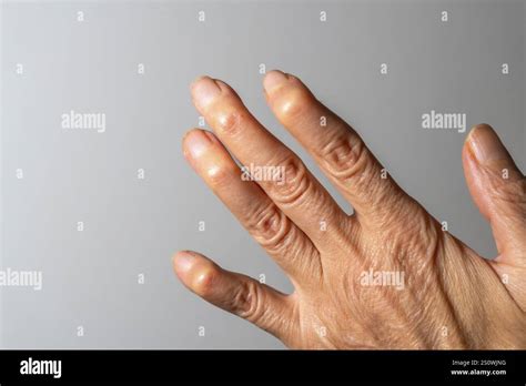 swollen hand joints