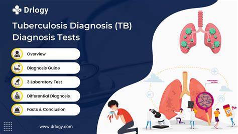 tb diagnosis