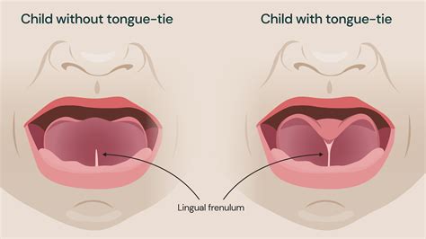 Tongue Tie