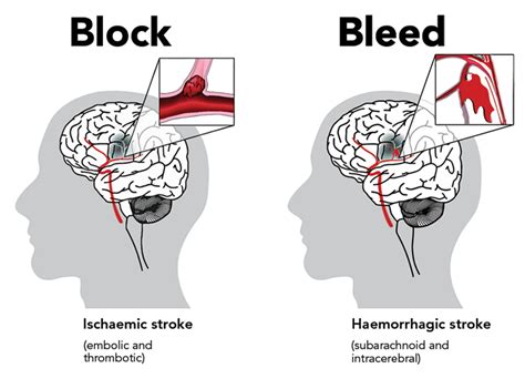 two main types of cva