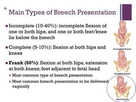 types of breech presentation slideshare