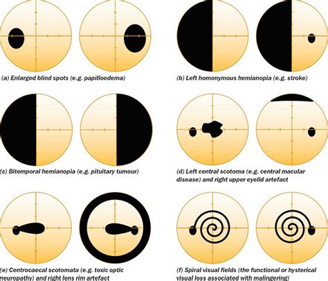 what are visual fields