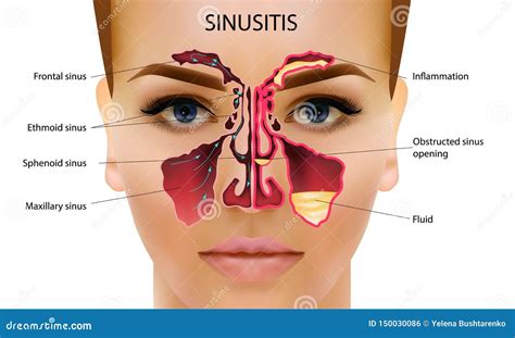 what can mimic sinusitis