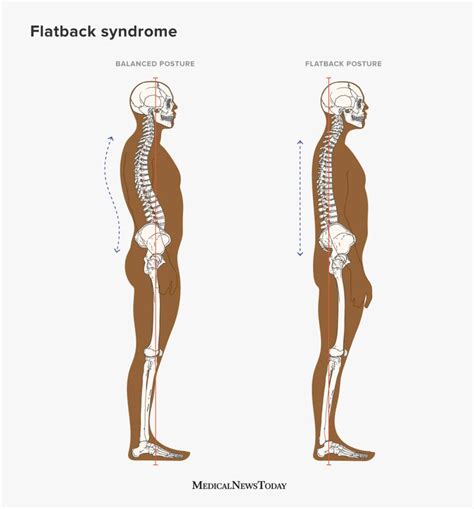 what causes a flat spine