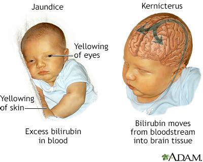 what causes bilirubin encephalopathy in newborns