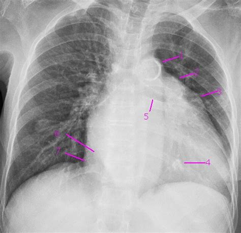 what causes calcification in mitral valve