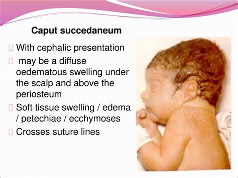 what causes caput